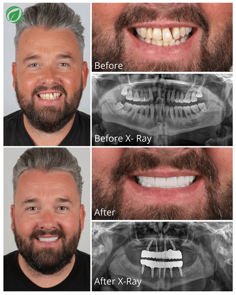 All-on-4 Dental Implant Treatment Result 1