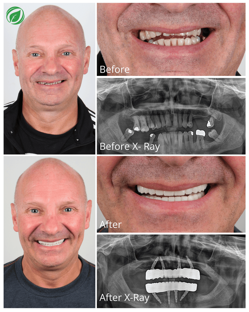 All-on-4 Dental Implant Treatment Result 2