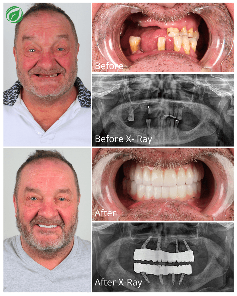 All-on-4 Dental Implant Treatment Result 3