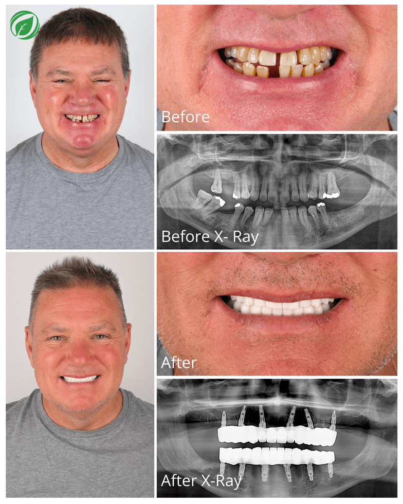 All-on-6 Dental Implant Treatment Result 1