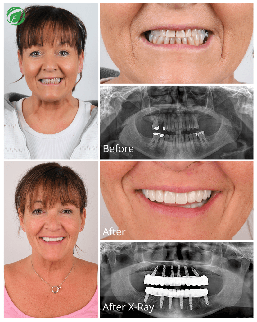 All-on-6 Dental Implant Treatment Result 2