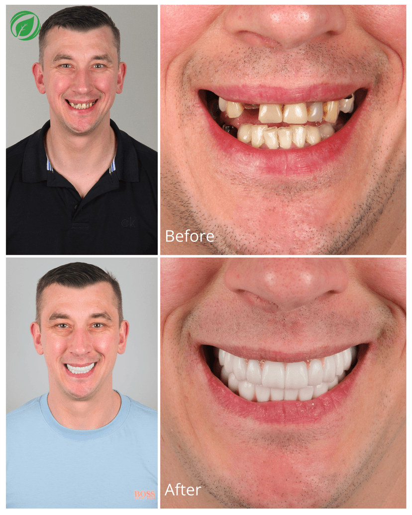 All-on-6 Dental Implant Treatment Result 3