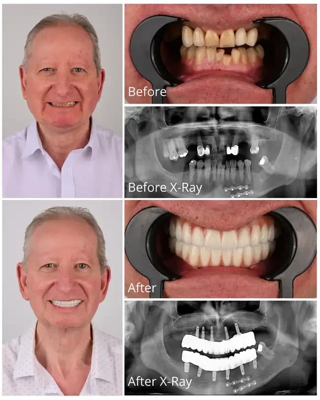 All-on-4 dental implants before and after treatment at OrbisMed Clinics, Antalya, Turkey