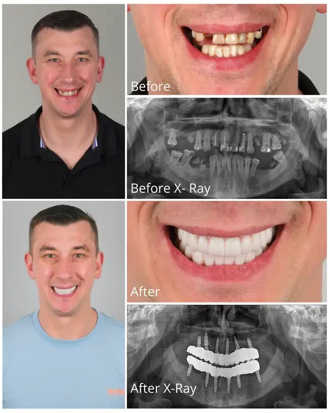 All-on-4 dental implants before and after treatment at OrbisMed Clinics, Antalya, Turkey