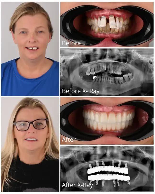 All-on-4 dental implants before and after treatment at OrbisMed Clinics, Antalya, Turkey