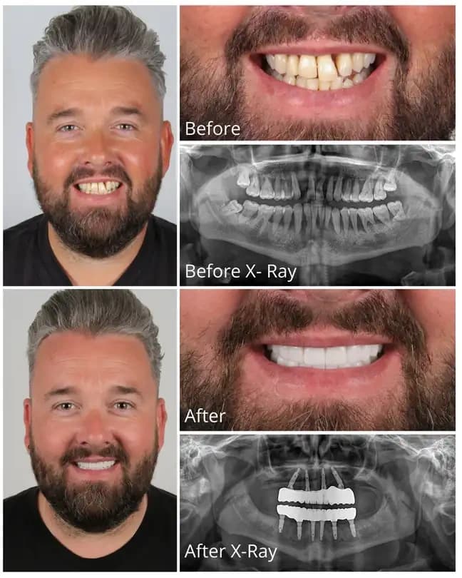All-on-4 dental implants before and after treatment at OrbisMed Clinics, Antalya, Turkey