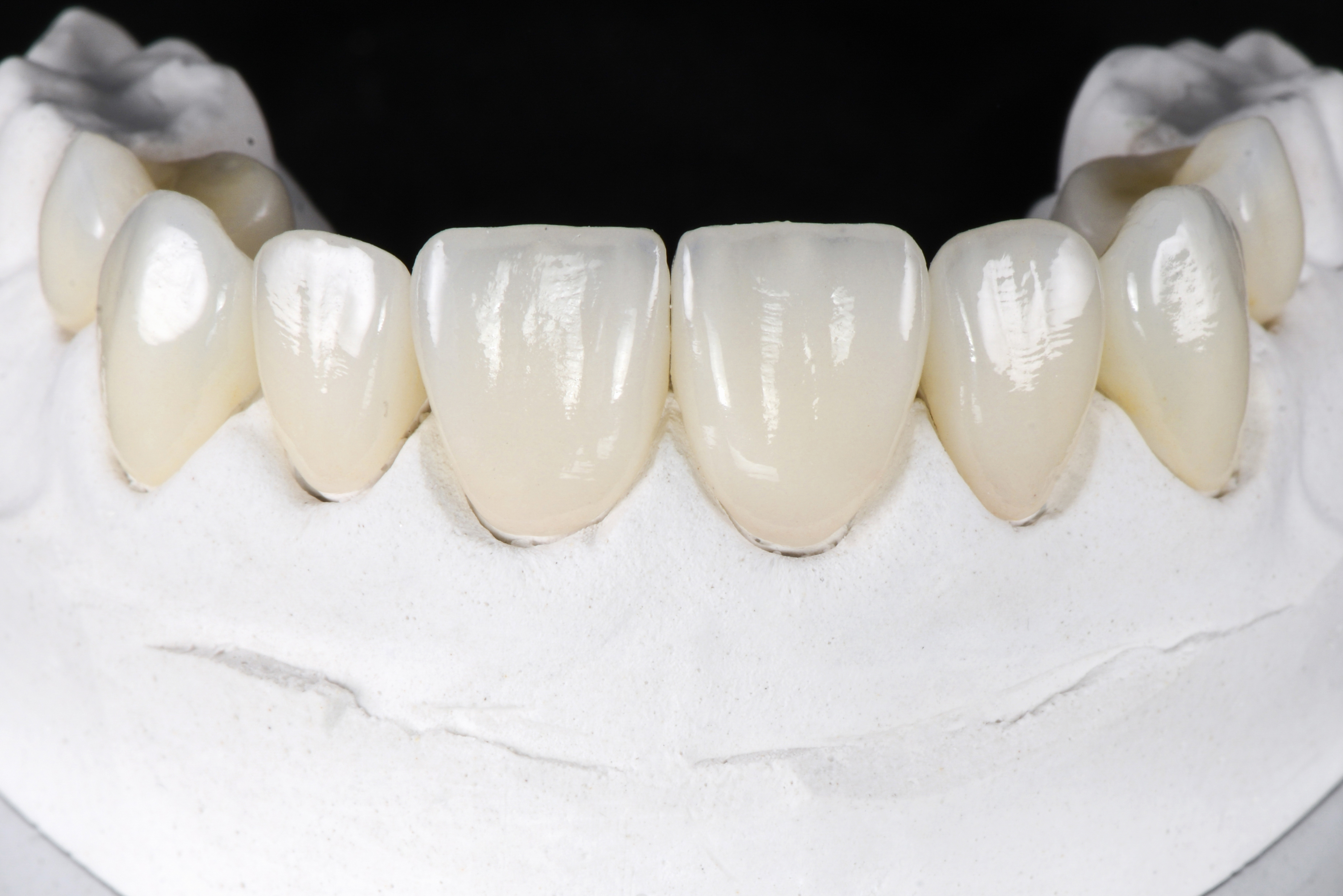 E-max Crowns