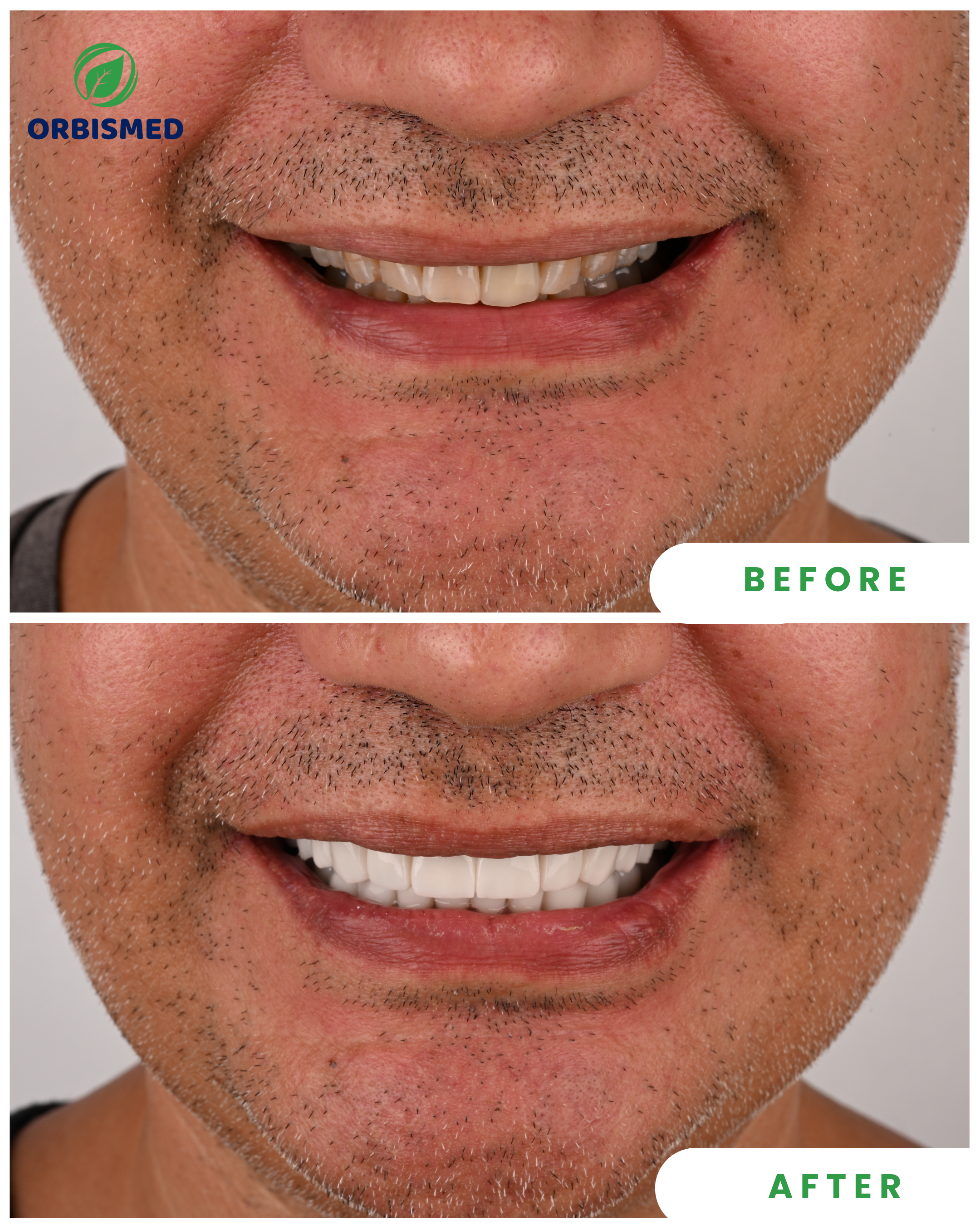 Composite Veneers