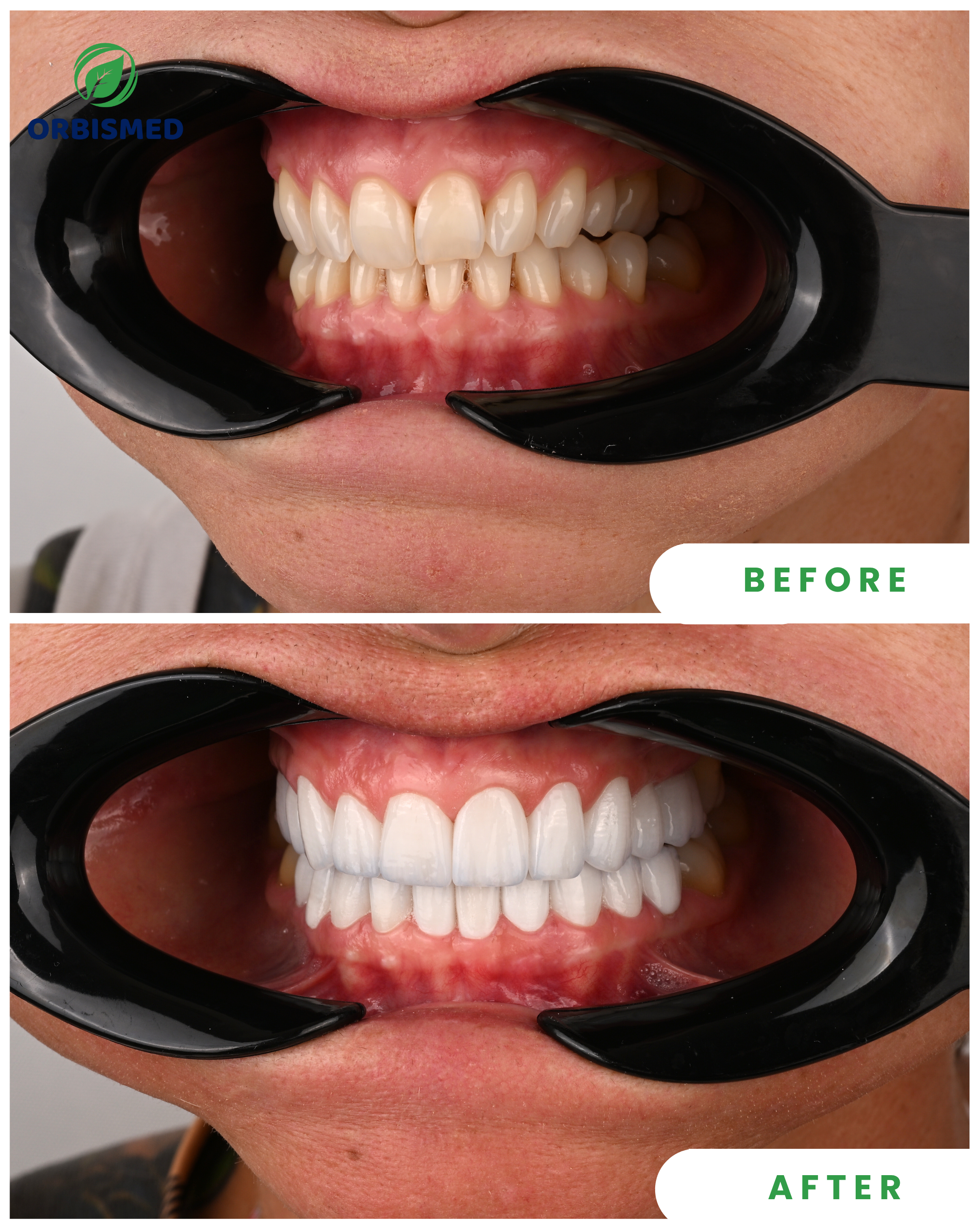 E-max Veneers