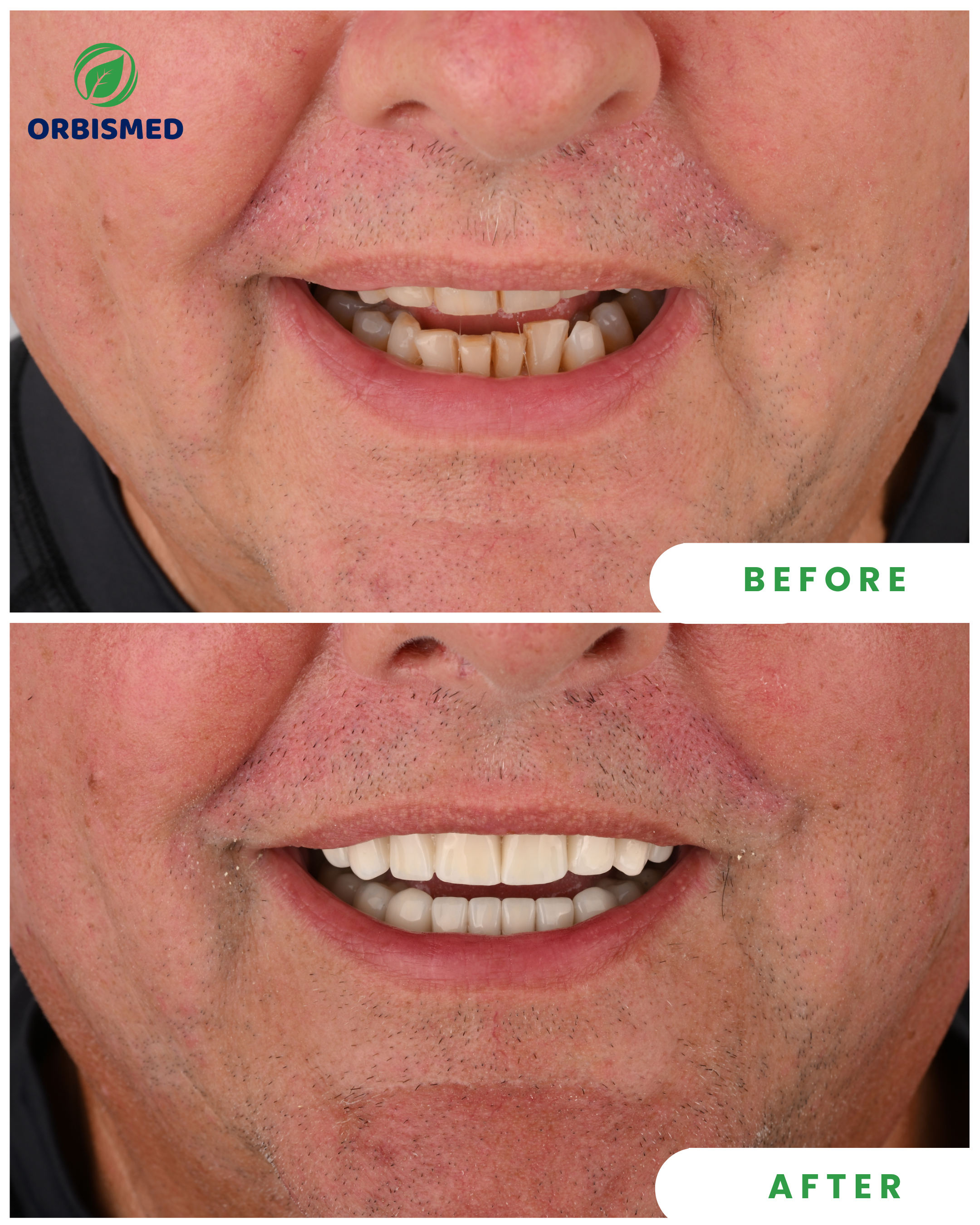 Porcelain Veneers