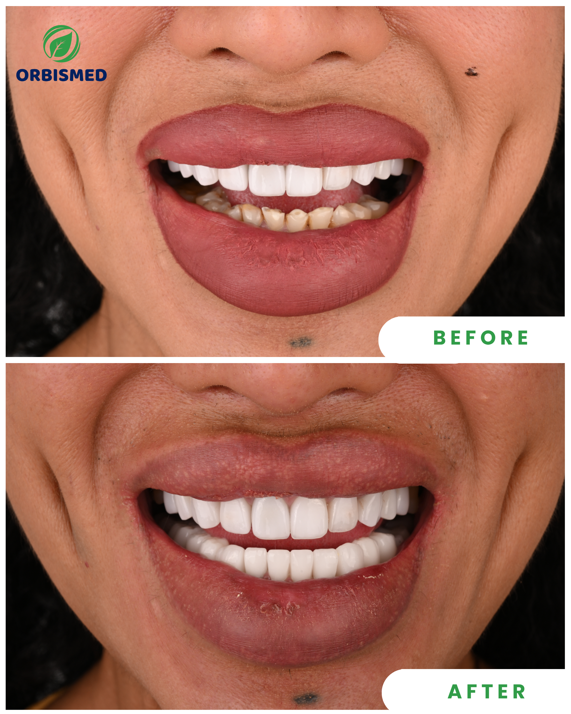 Zirconia Veneers