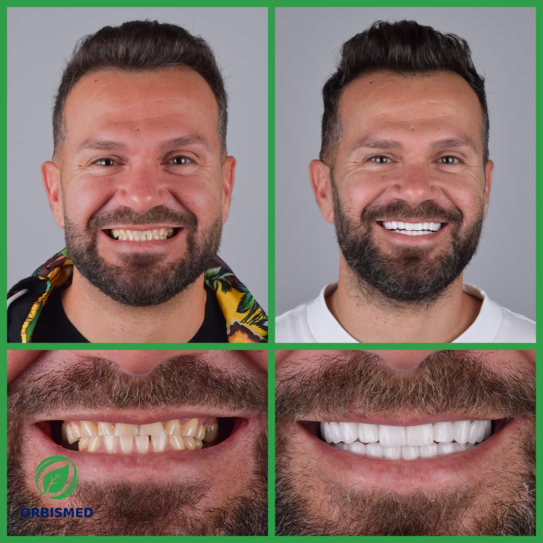 Patient 87 - Before & After