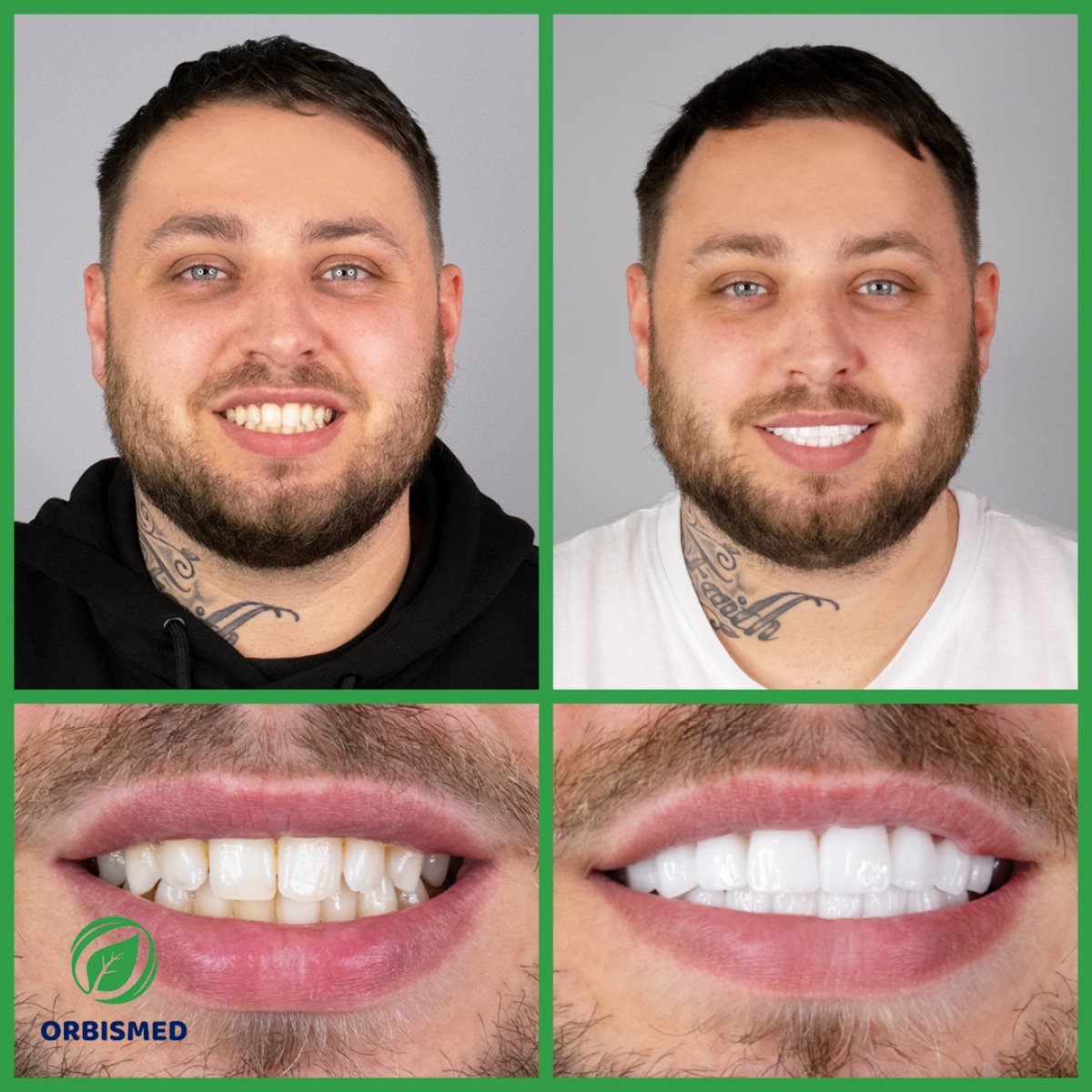Patient 88 - Before & After