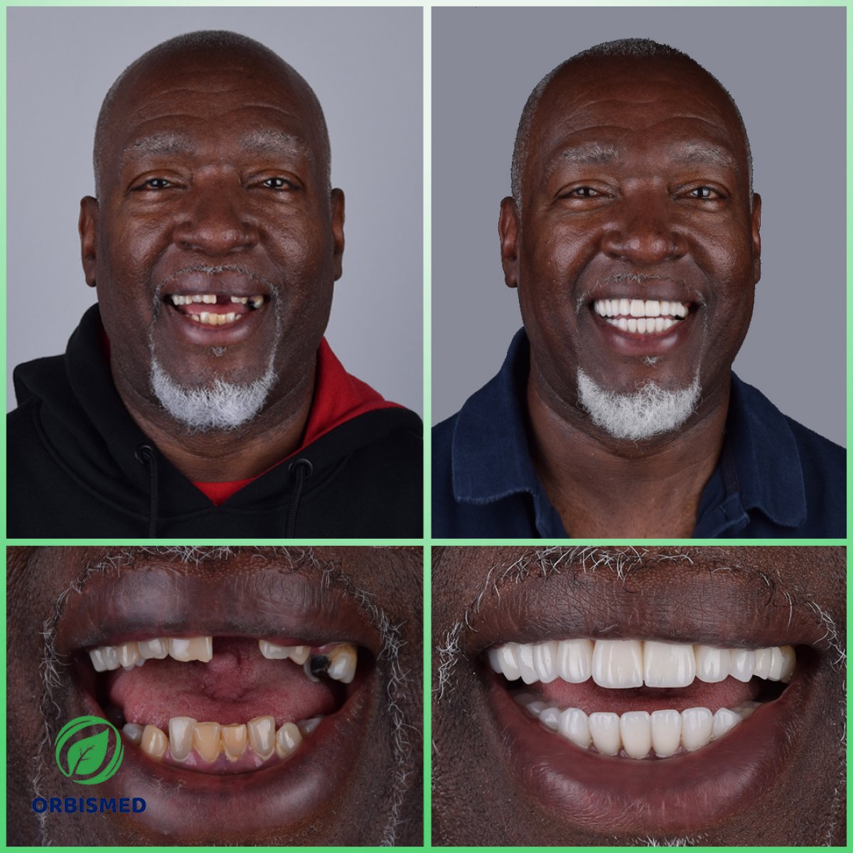 Patient 90 - Before & After