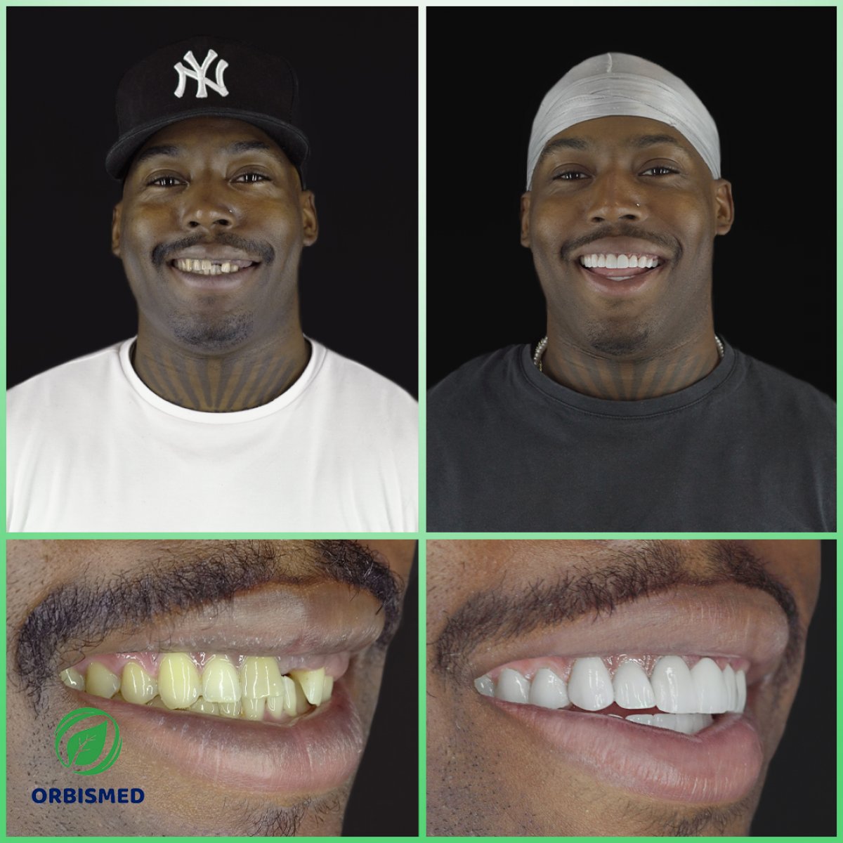 Patient 84 - Before & After
