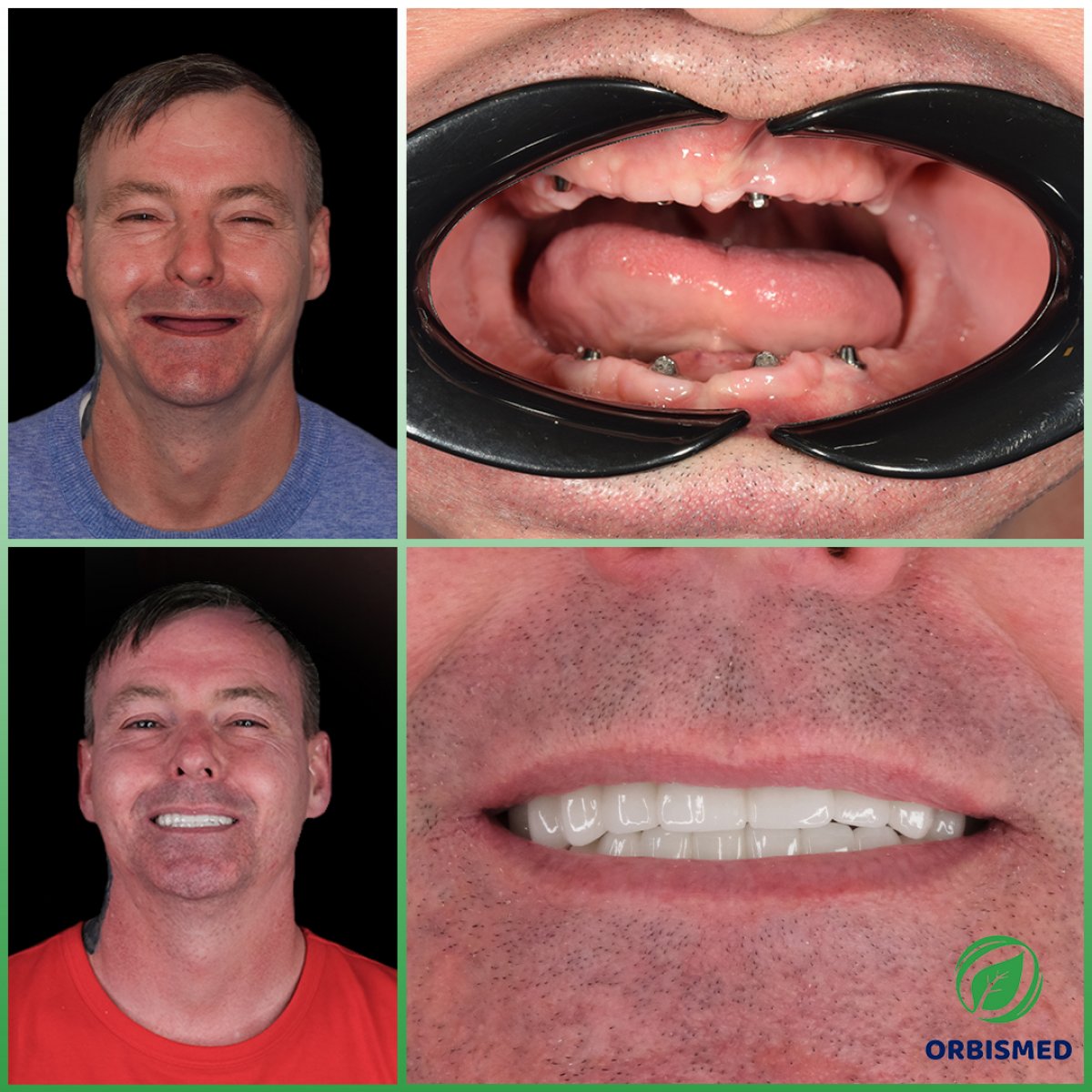 Patient 85 - Before & After