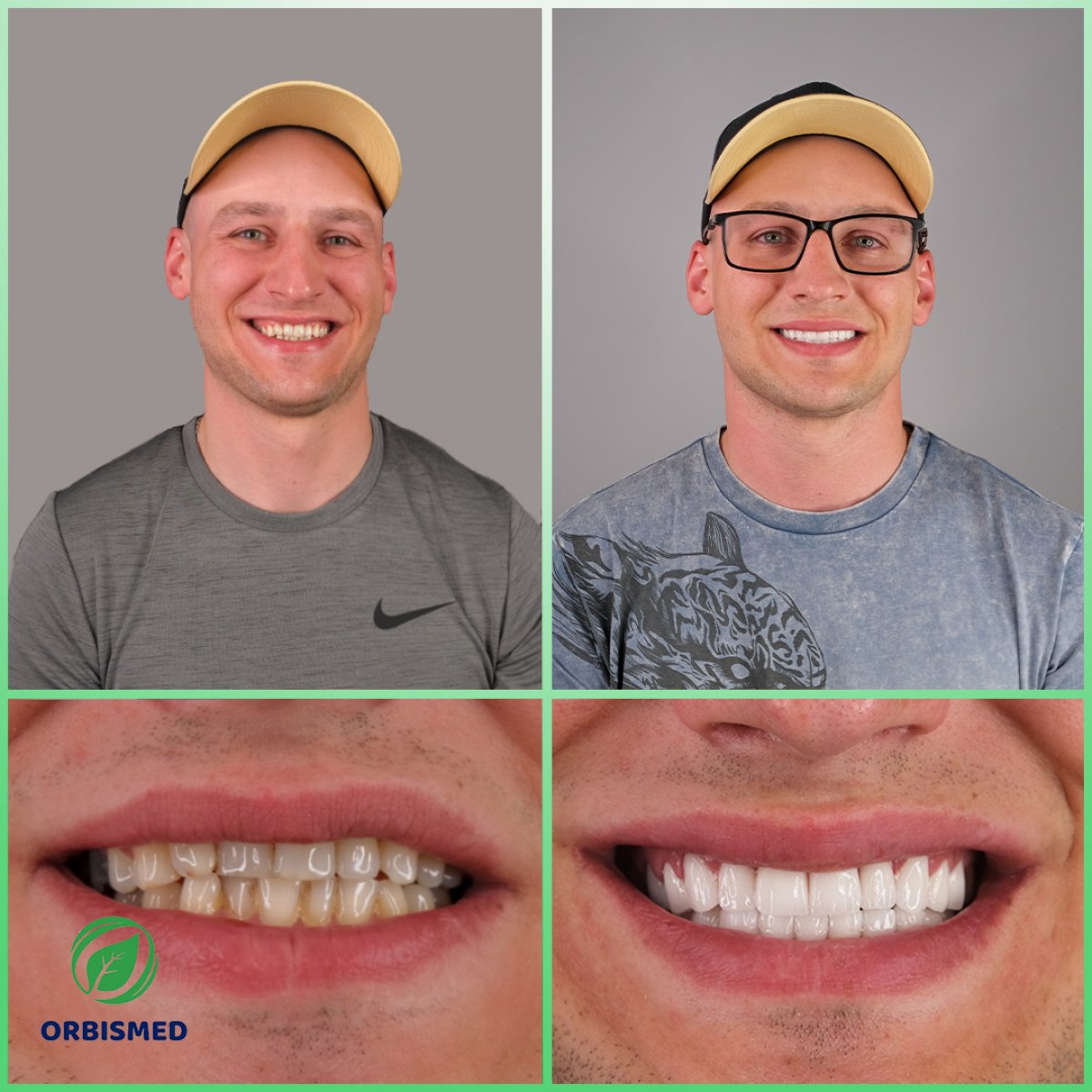 Patient 86 - Before & After