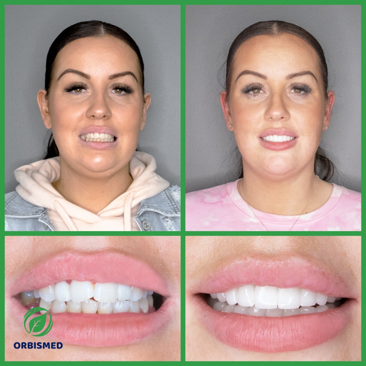 Patient 78 - Before & After