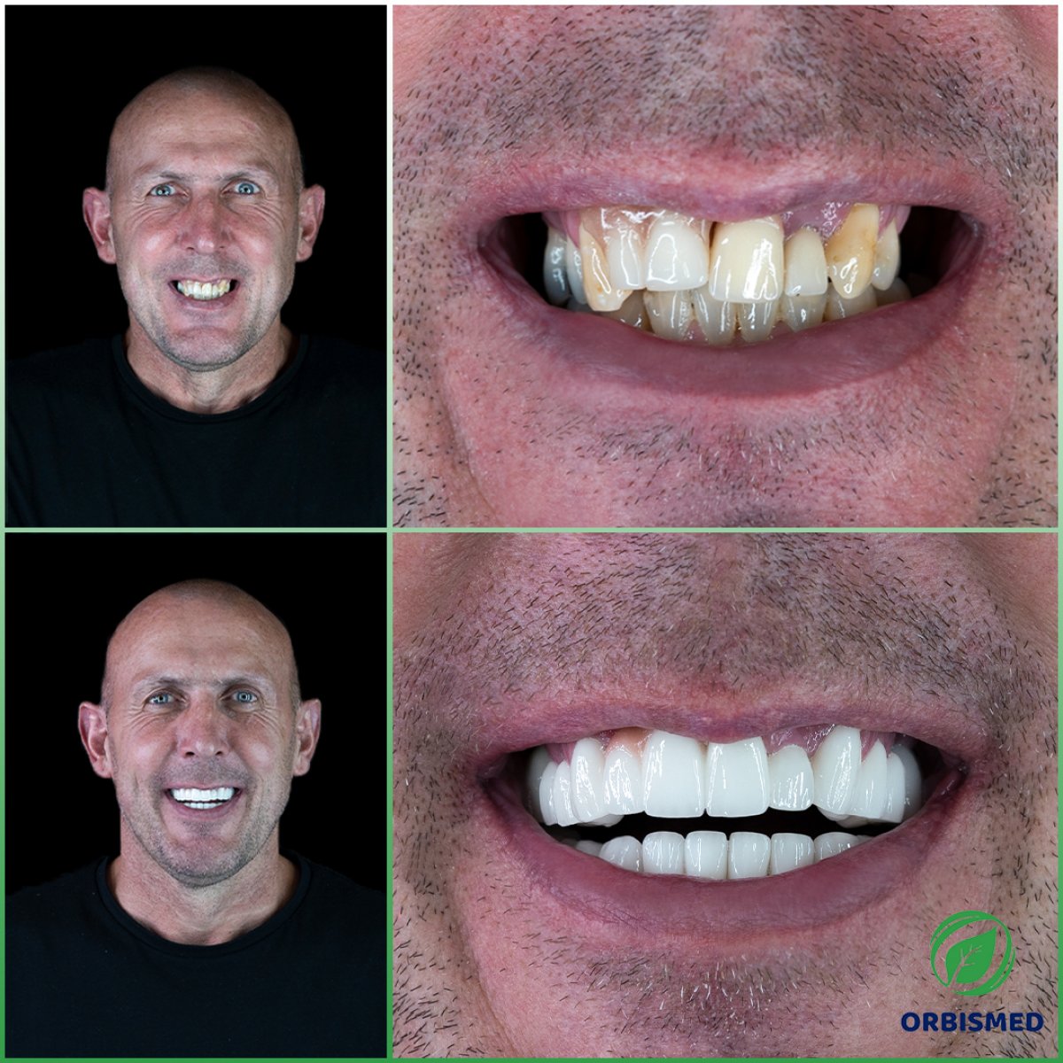 Patient 80 - Before & After