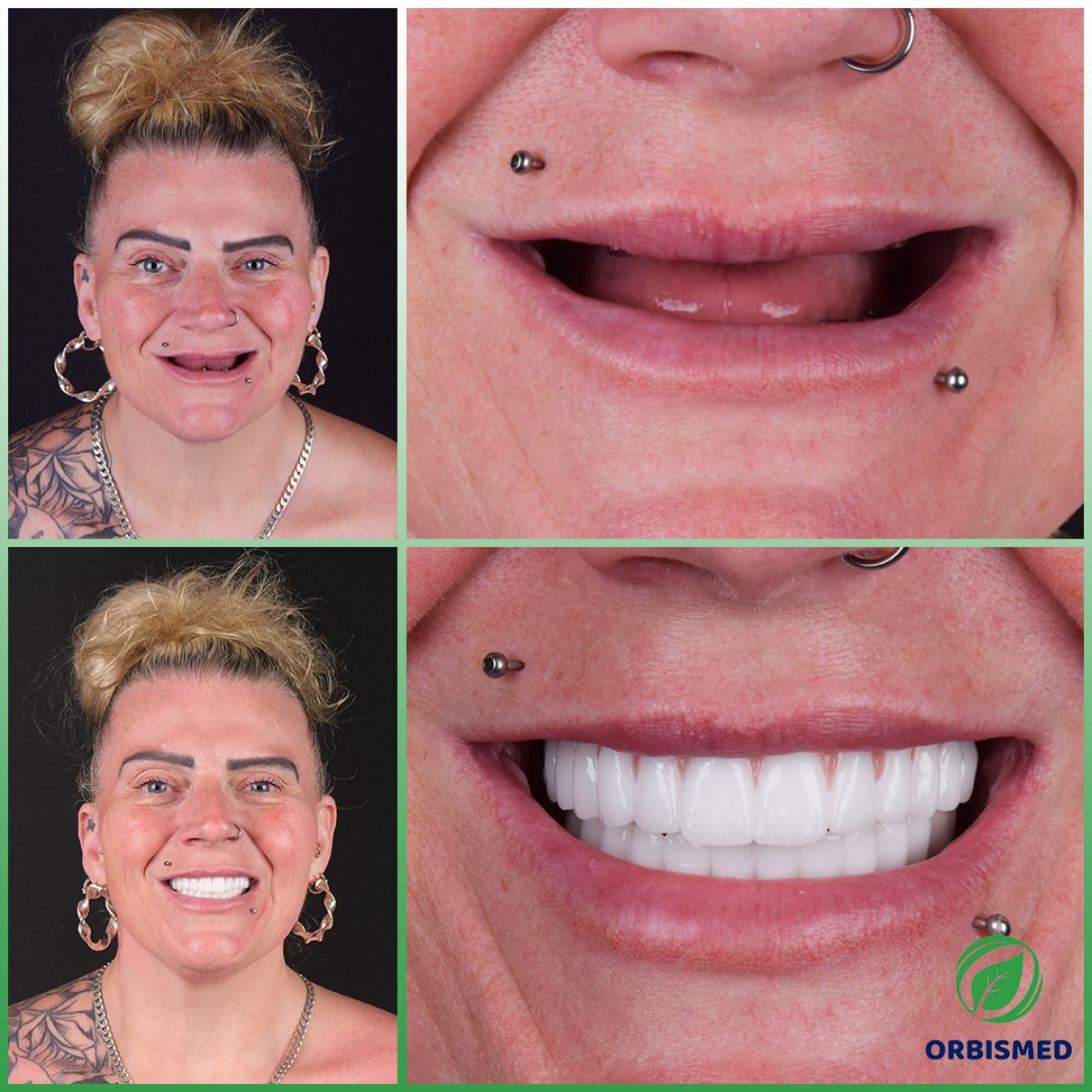 Patient 82 - Before & After