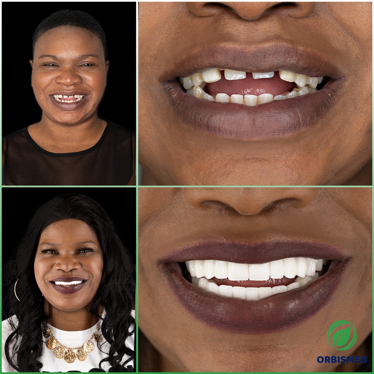 Patient 74 - Before & After