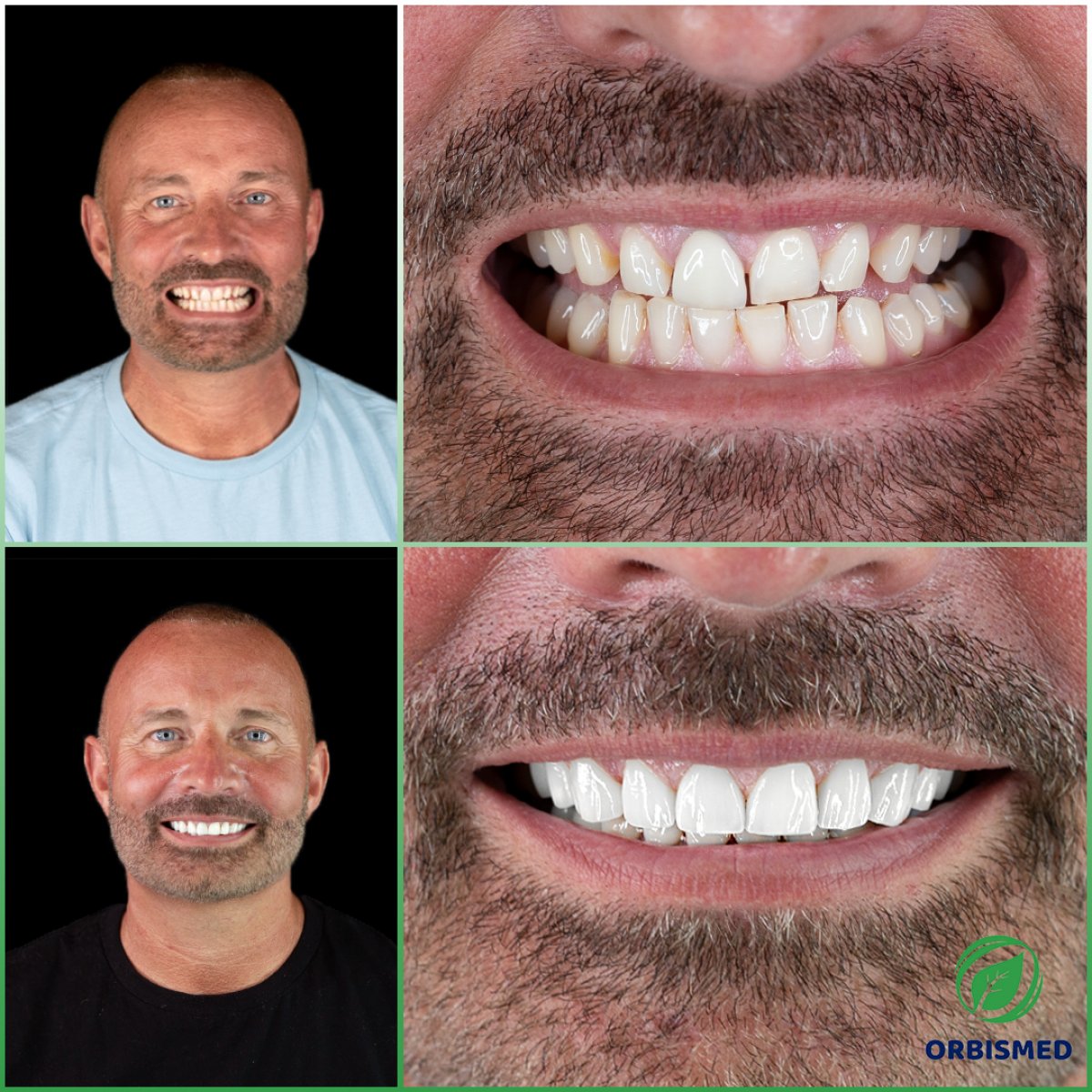 Patient 75 - Before & After