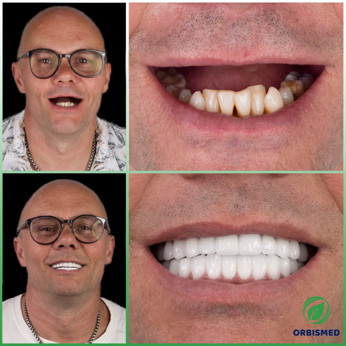 Patient 70 - Before & After