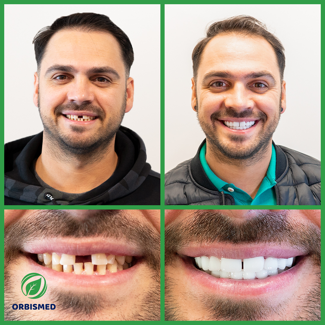 Patient 67 - Before & After