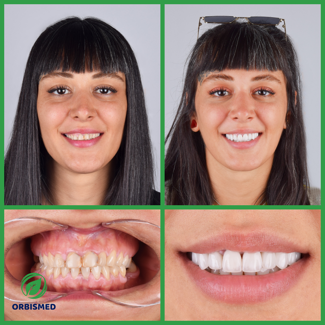 Patient 68 - Before & After