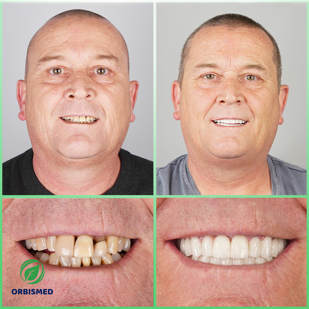 Patient 58 - Before & After