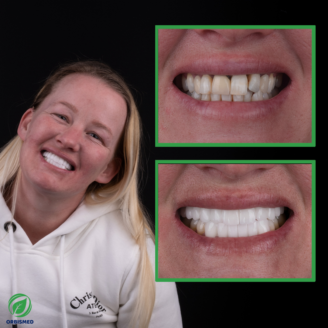 Patient 54 - Before & After
