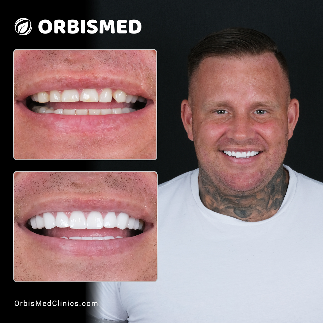 Patient 56 - Before & After