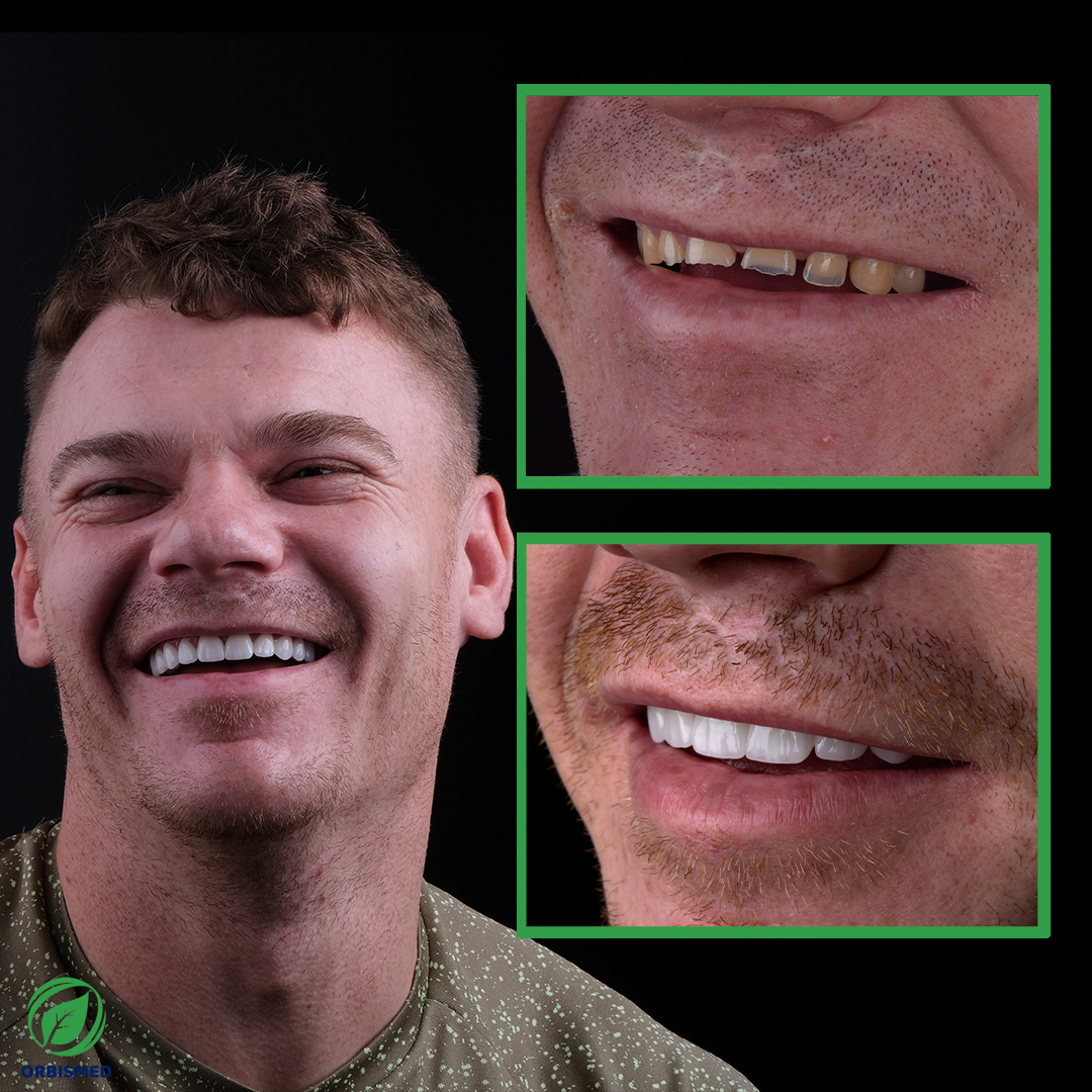 Patient 57 - Before & After