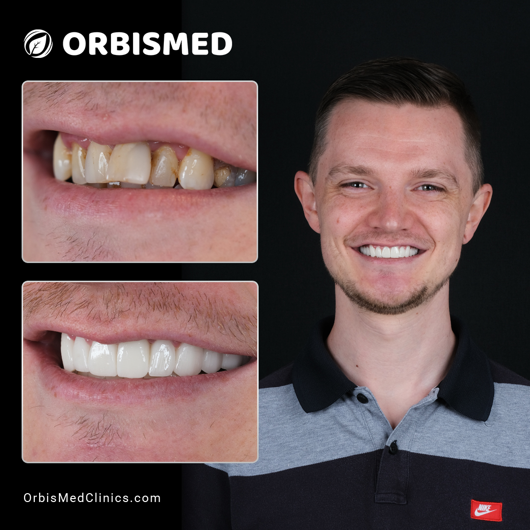 Patient 48 - Before & After