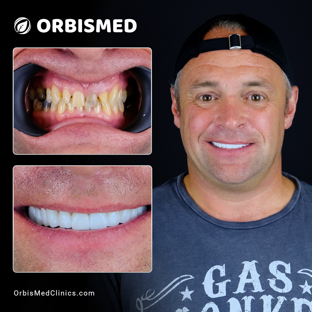 Patient 52 - Before & After