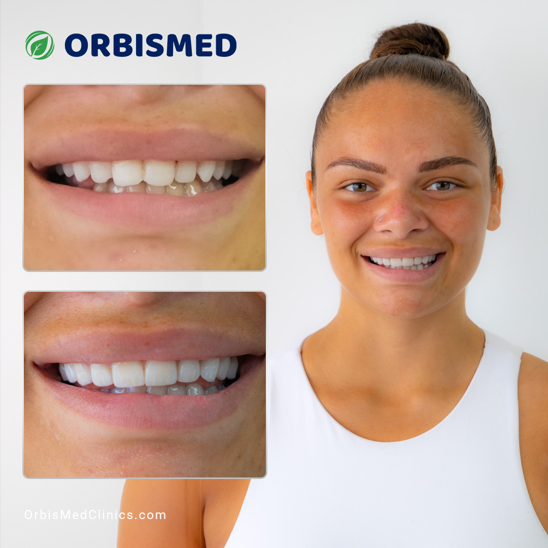 Patient 44 - Before & After