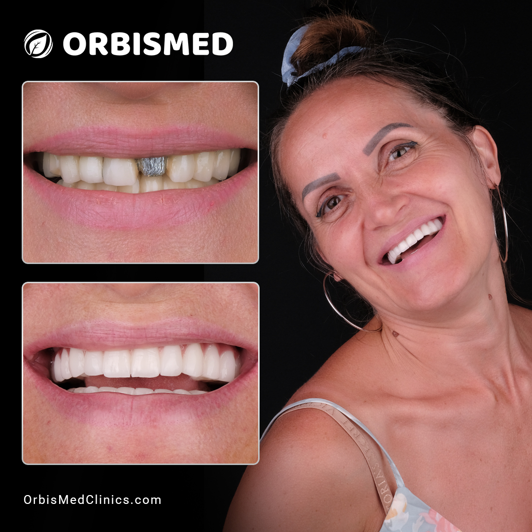 Patient 39 - Before & After