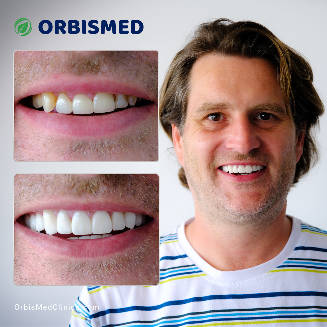 Patient 40 - Before & After