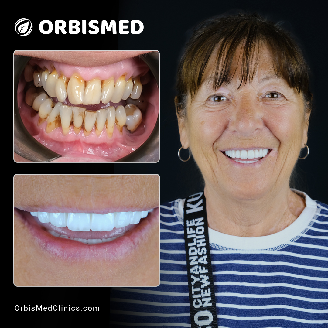 Patient 41 - Before & After