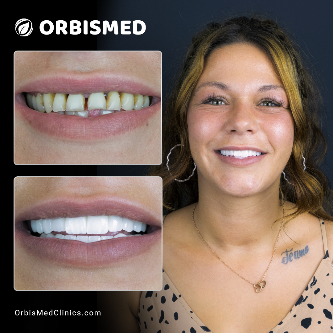 Patient 32 - Before & After