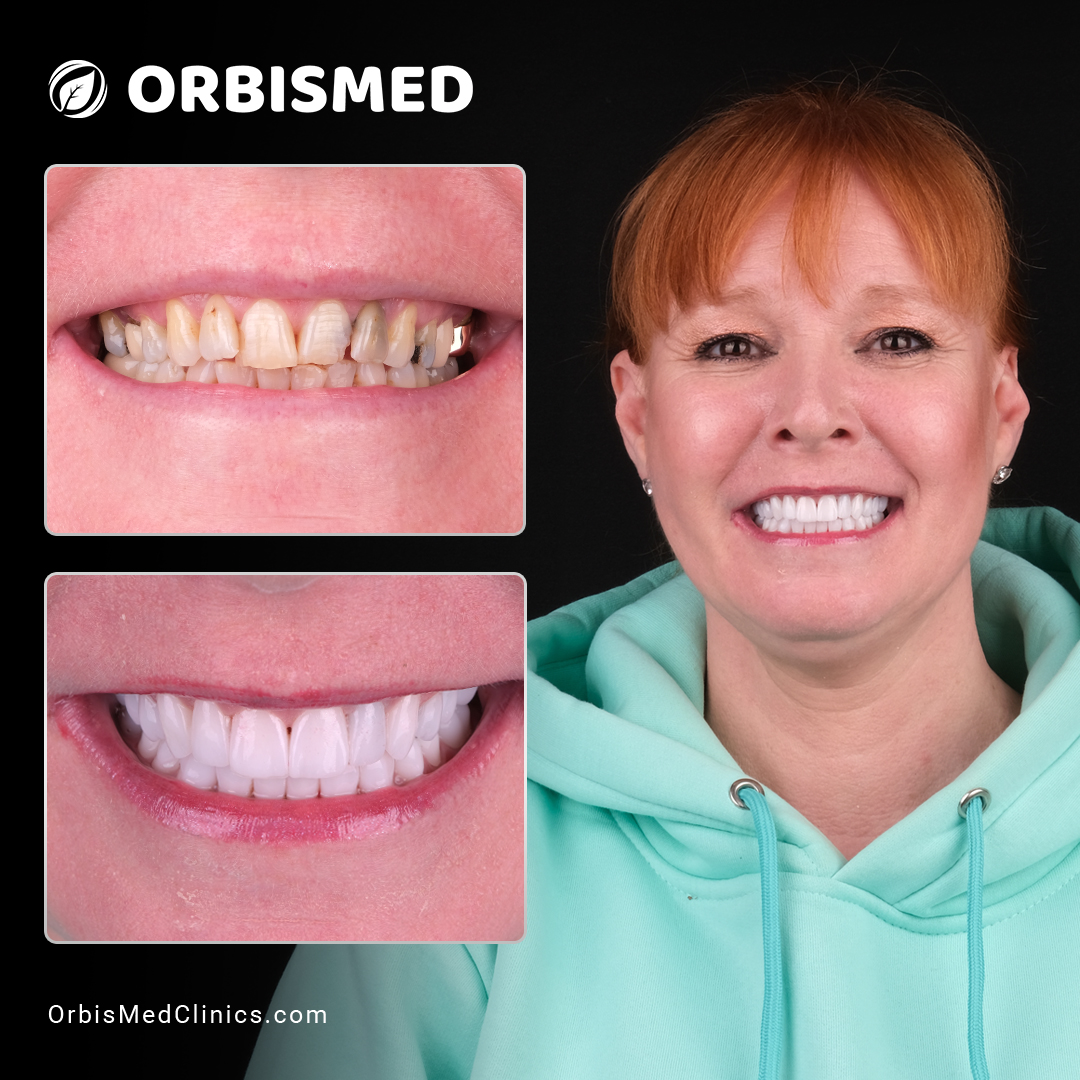 Patient 34 - Before & After