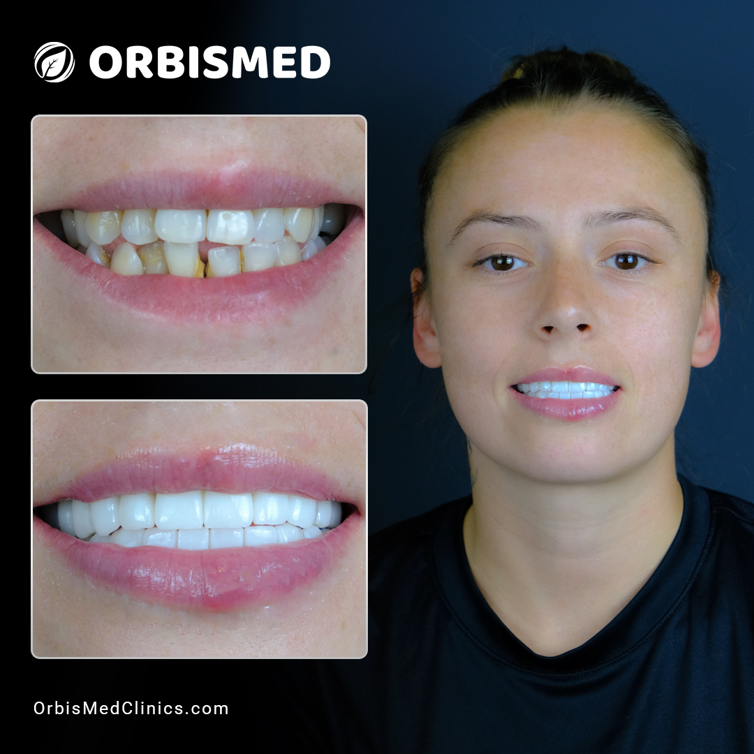 Patient 23 - Before & After
