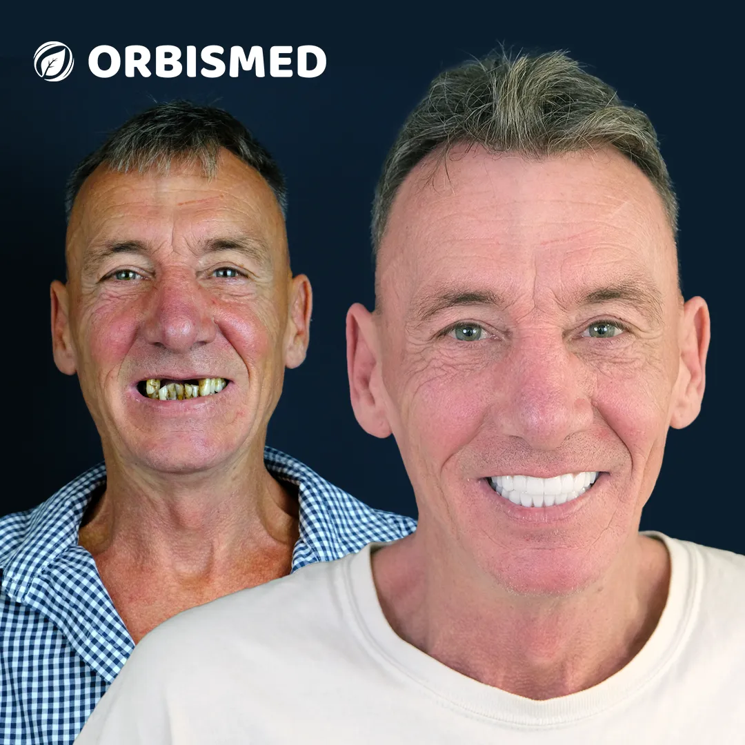 Patient 17 - Before & After