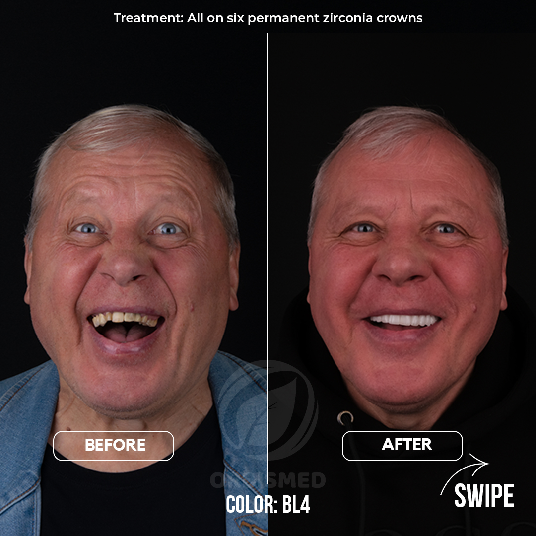 Patient 13 - Before & After