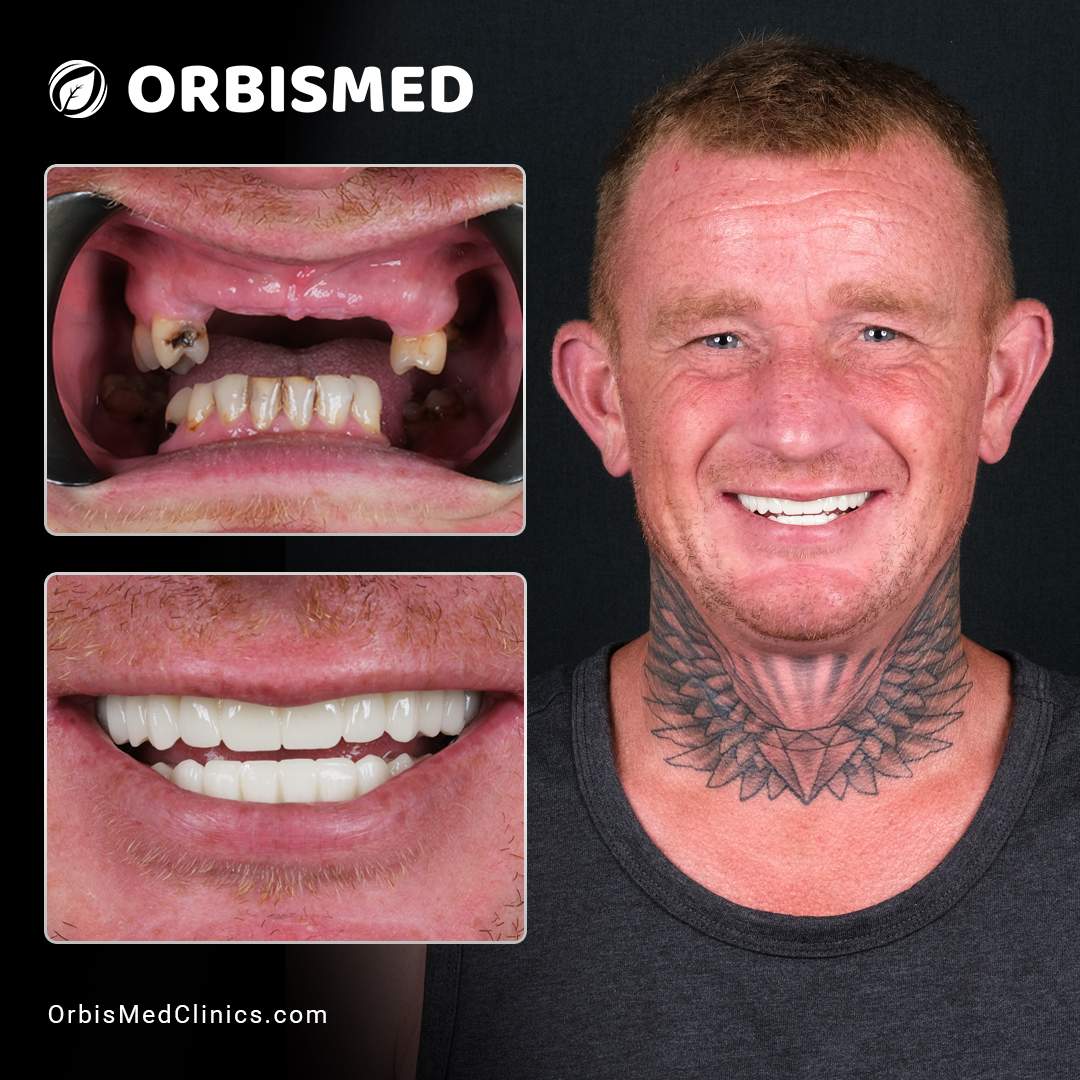 Patient 14 - Before & After
