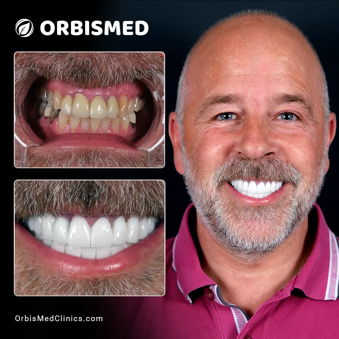 Patient 4 - Before & After