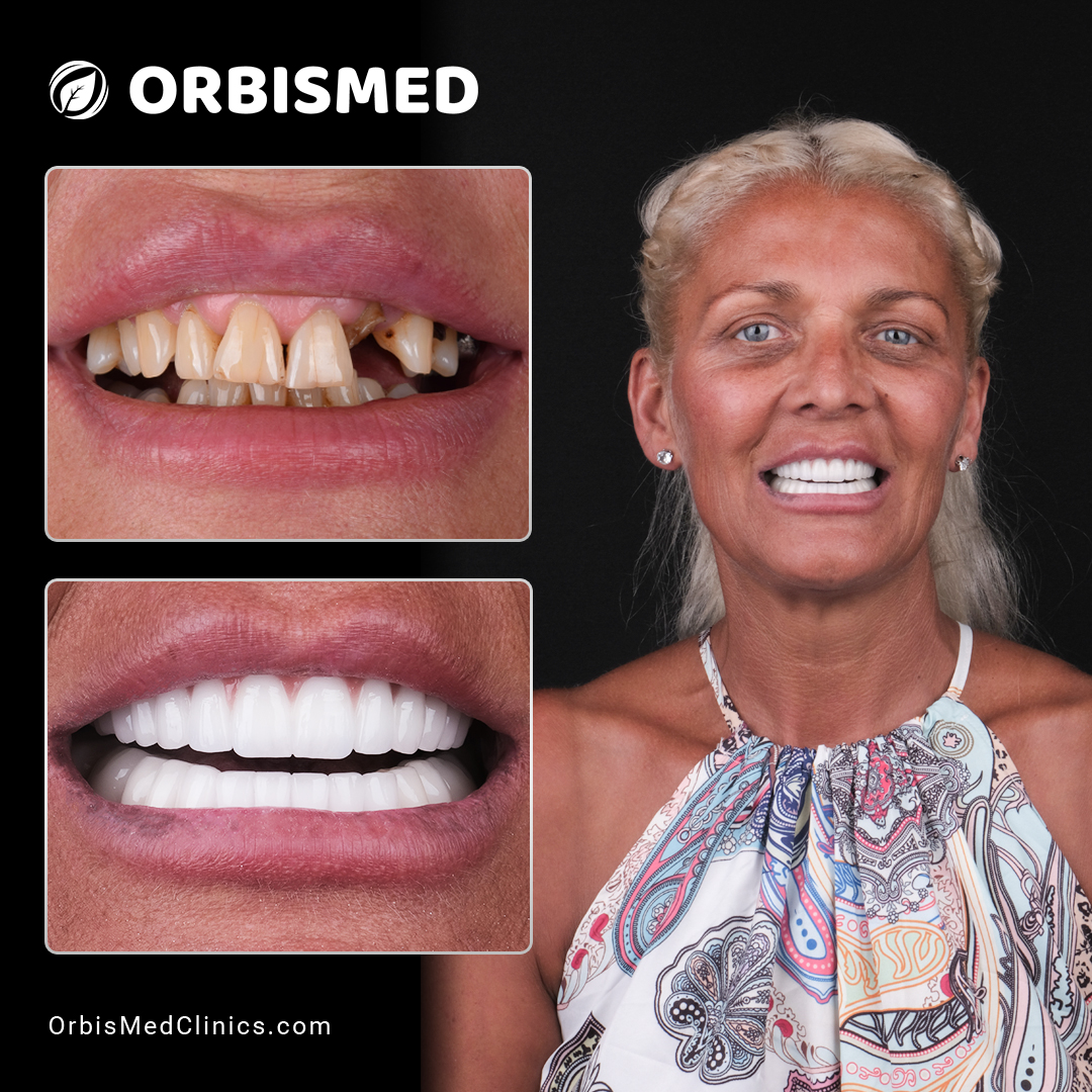 Patient 10 - Before & After