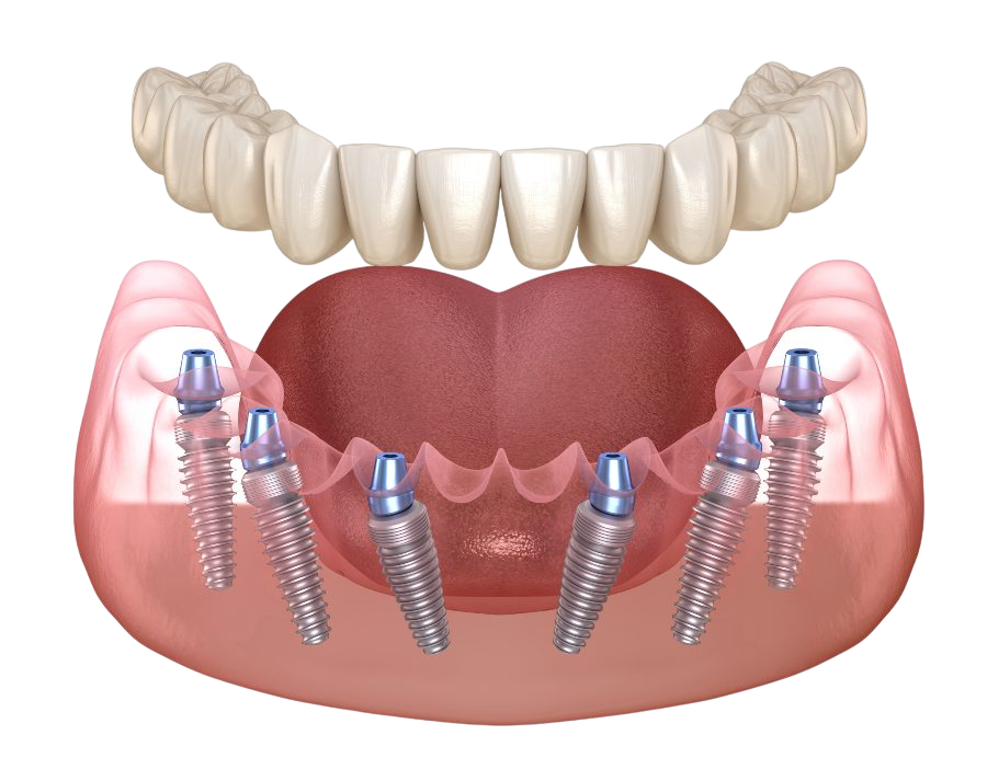 3 ON 6 Dental Implants