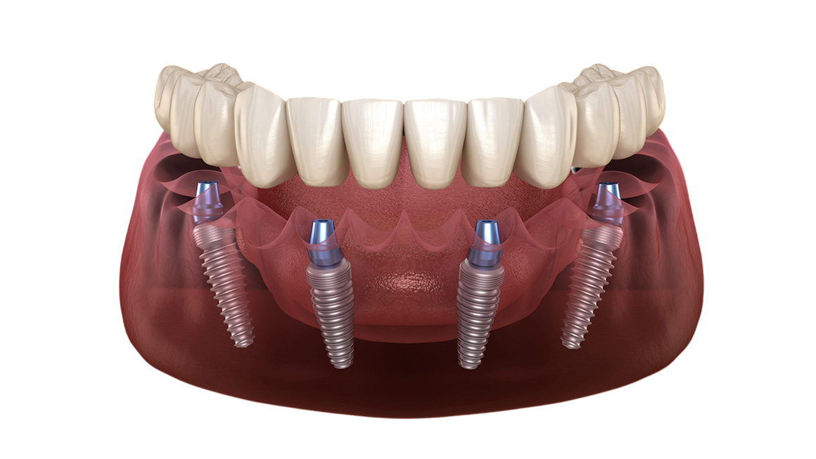ALL ON 4 Dental Implants