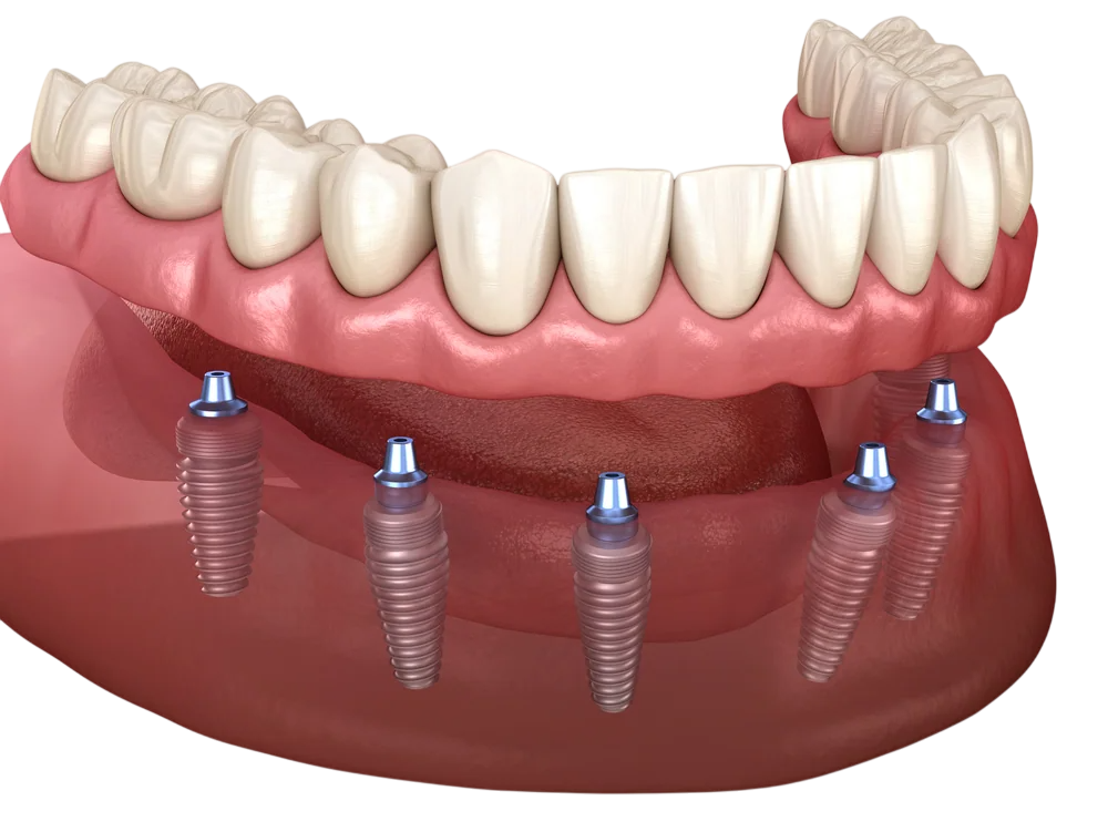 ALL ON 6 Dental Implants